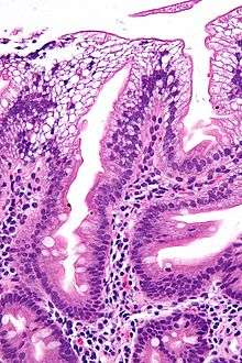 Abetaliporoteinemide karakteristik berrak sitoplazmalı enterositleri gösteren mikrograf